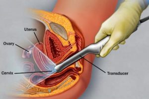 gynekologisk ultraljudsundersökning